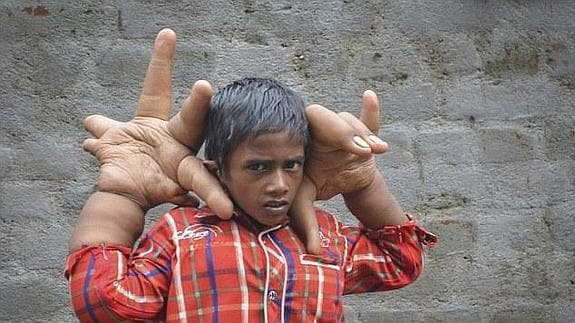 Las manos gigantes de un niño indio para el que no encuentran cura