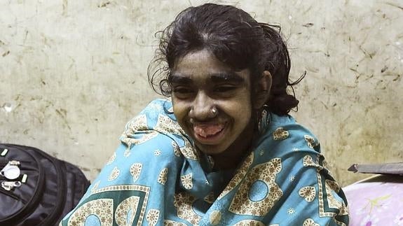 Bithi, la 'niña lobo', será operada en Dacca. 