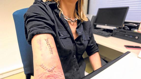 Mari Jose muestra algunas de las heridas que le causó la vaca con sus embestidas.