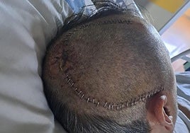 Francisco José Ramón recibió un fuerte impacto en la cabeza del que fue operado en el Caule de León.