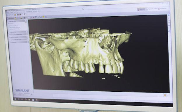 Cómo cuidar los implantes dentales para que duren más tiempo