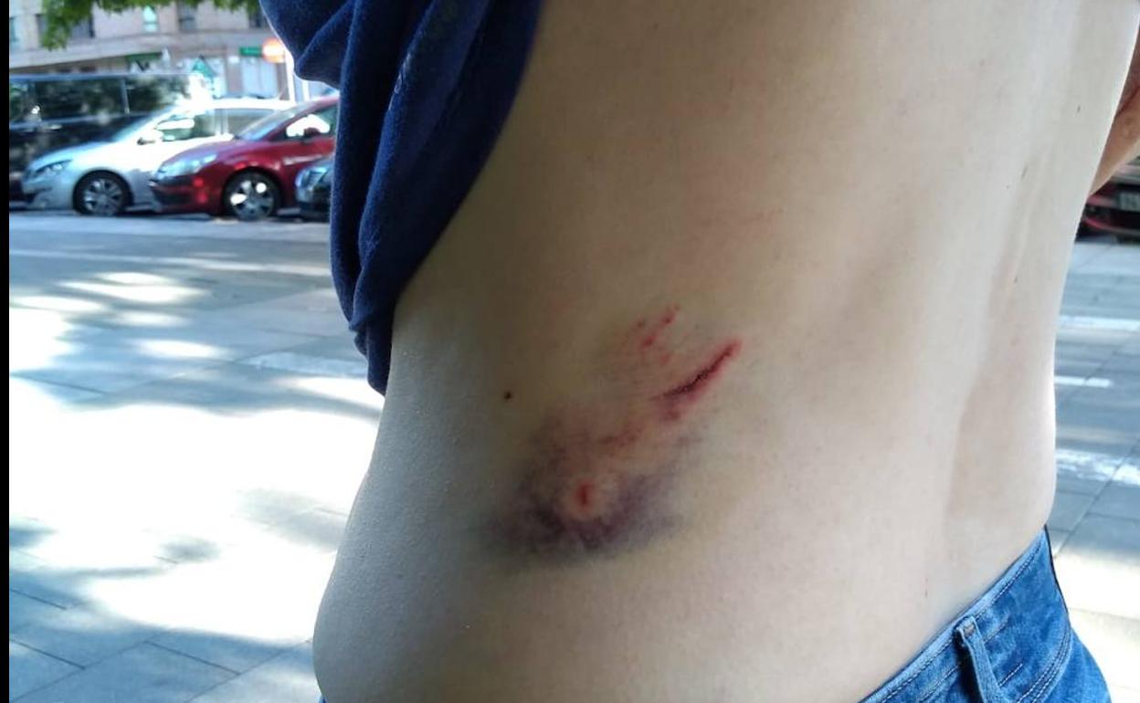 La mordedura que recibió en su costado la mujer. 