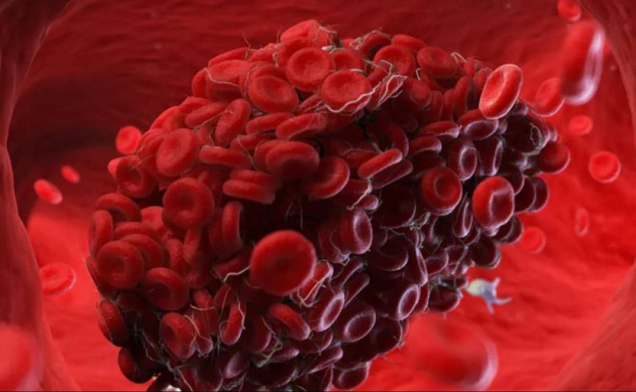 Coágulos sanguíneos y covid-19: cinco factores de riesgo