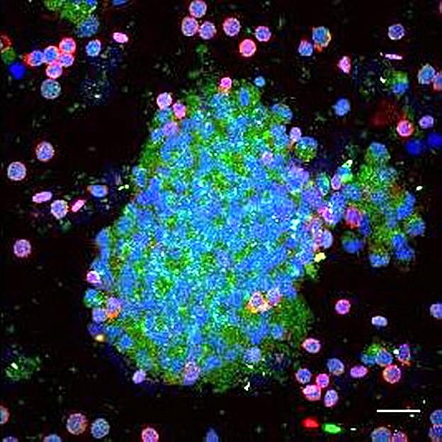Crean tumores de laboratorio para predecir las recaídas de la enfermedad