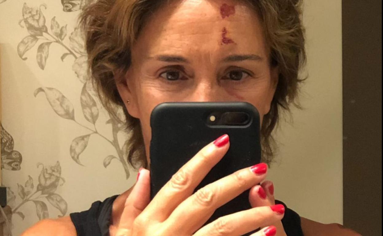 Lydia Bosch muestra las heridas de su accidente. 