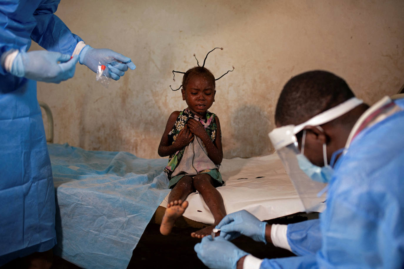 Theopiste Maloko, de 42 años, funcionario de salud local, y una enfermera recolectan muestras de piel de Angelika Lifafu, de 6 años, en el centro de salud de Yalolia (República Democrática del Congo). . Sin tratamiento, Angelika sólo puede esperar a que la enfermedad siga su curso. 