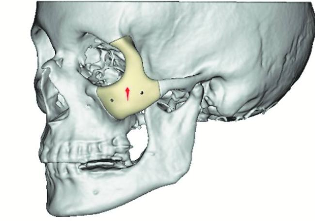 Simulación en 3D de la intervención en el malar, con la prótesis de Peek en la zona en la que estaba el tumor.