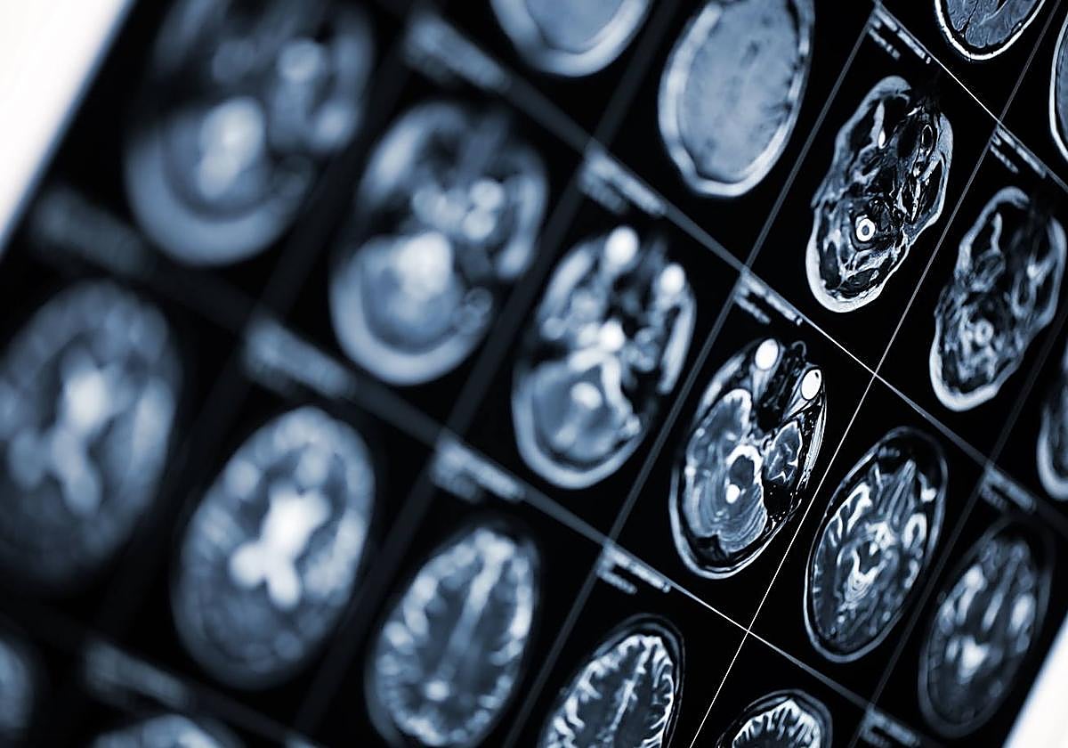 «Nos dijeron que un mes más de demora y habría quedado en silla de ruedas por el tumor»