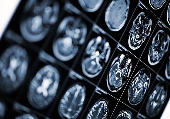 «Nos dijeron que un mes más de demora y habría quedado en silla de ruedas por el tumor»