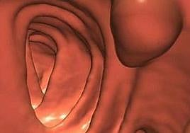 Imagen de una colonoscopia generada por ordenador.