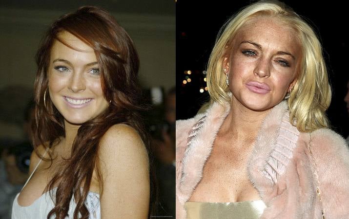 Lindsay Lohan, antes y después de operarse. 