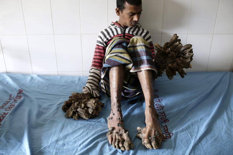 Abul Bajandar, el &#039;hombre árbol&#039;