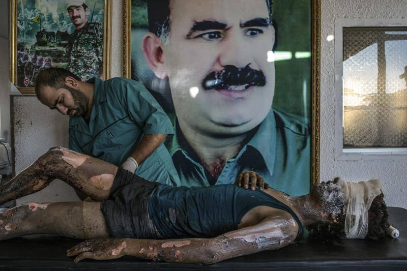 La fotografía muestra a un doctor aplicando pomada a un joven de 16 años, miembro del grupo terrorista autoproclamado Estado Islámico, frente a un poster con el rostro Abdullah Öcalan, el presidente del Partido de los Trabajadores de Kurdistán, en un hospital a las afueras de Hasaka (Siria) .