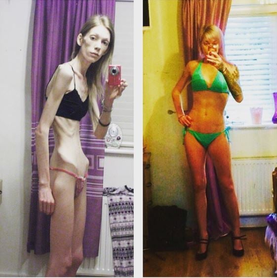 Nicola King, la joven anoréxica que se convirtió en campeona de fisicoculturismo