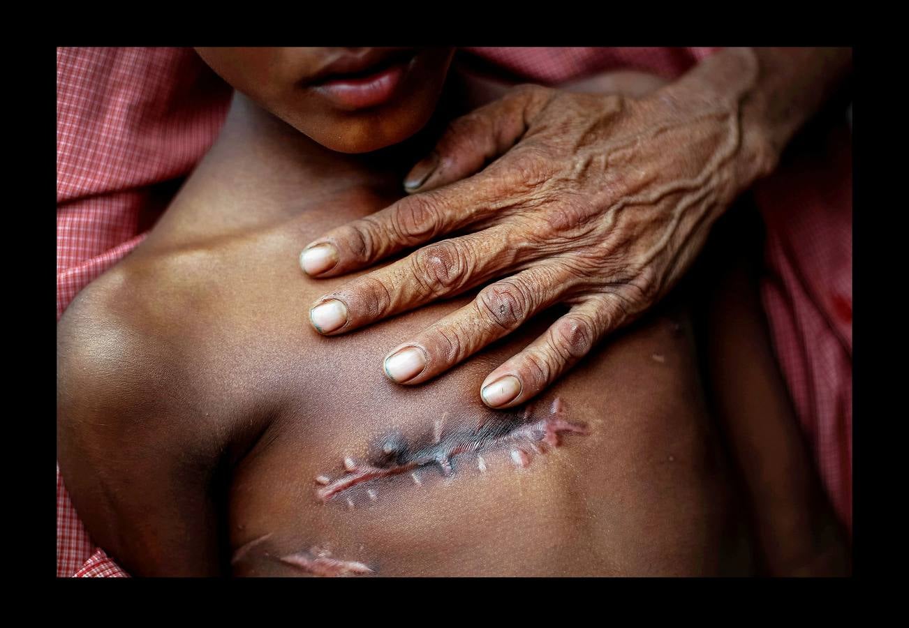 Mohammed Shoaib, de 7 años, recibió un disparo en el pecho antes de cruzar la frontera de Myanmar, el 5 de noviembre de 2017.