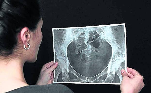 Una afectada mira su radiografía con los dos 'essure' colocados en las trompas de falopio. 