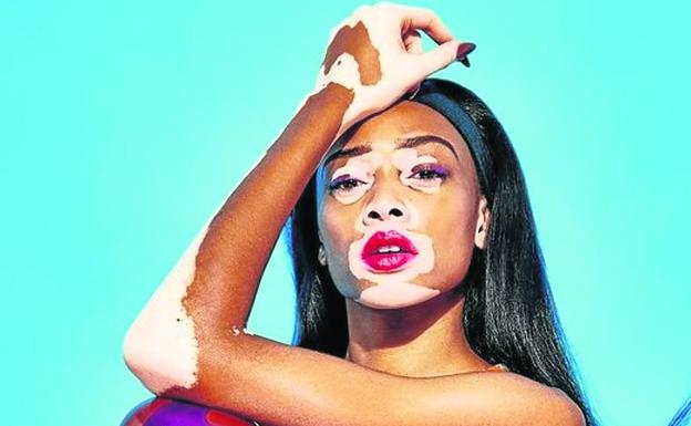 Winnie Harlow sufre de vitíligo. 