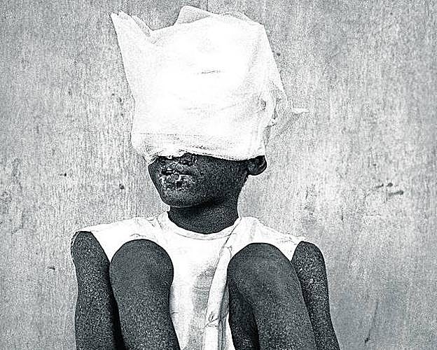 Mackenson, 5 años, poco antes de morir por cáncer de piel, en Haití. 