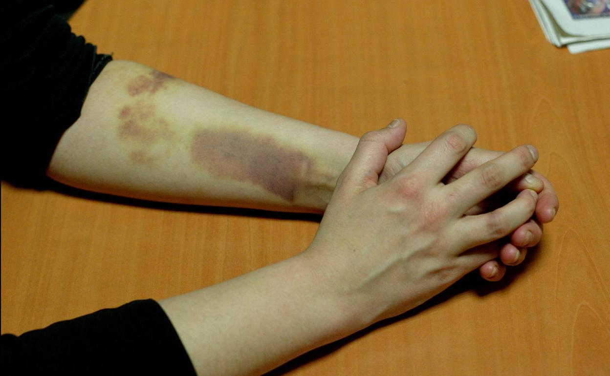 Una mujer maltratada muestra los hematomas del antebrazo.