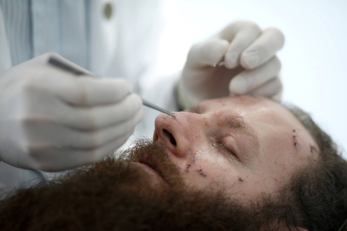 El cirujano plástico Dr. Joe Baroud, que ofrece sus servicios de forma gratuita a las personas heridas por una explosión masiva en el área del puerto, quita los puntos de sutura del rostro de Shady Rizk en Beirut.