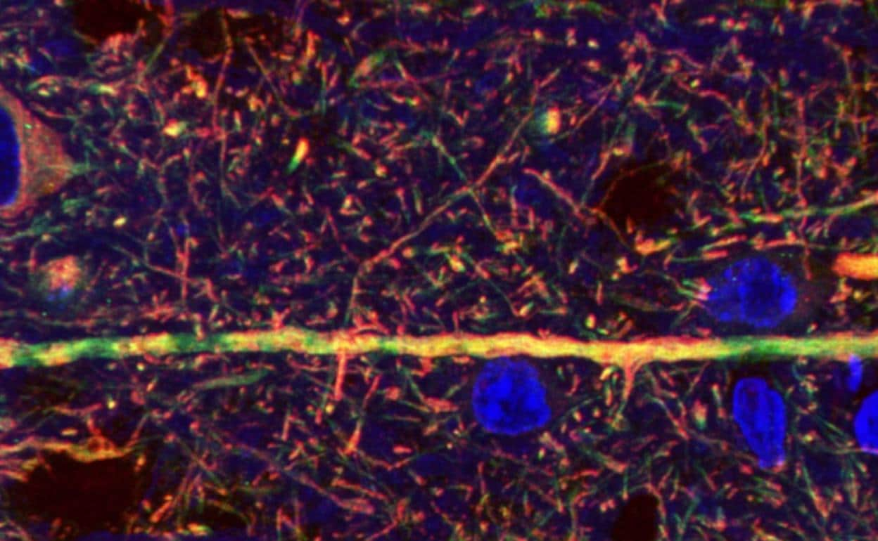 Descubren alteraciones en las proteínas del hipocampo en enfermos de  Parkinson | El Correo