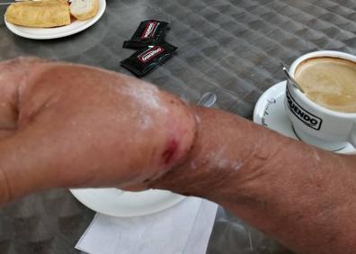 Imagen secundaria 1 - «Tengo la muñeca destrozada, todavía hoy sigo llorando»