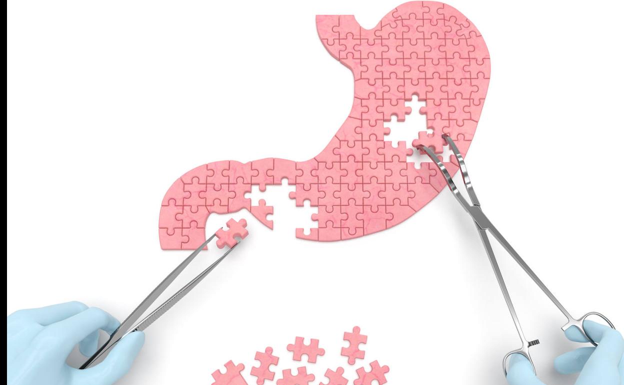 Más cirugía de la obesidad. ¿Por qué ha aumentado un 30% a causa de la pandemia?