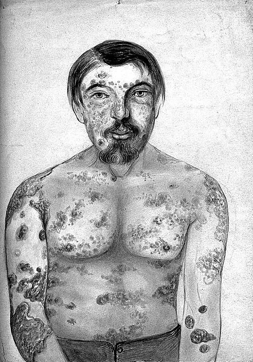 Acuarela de un hombre con sífilis (1866). 
