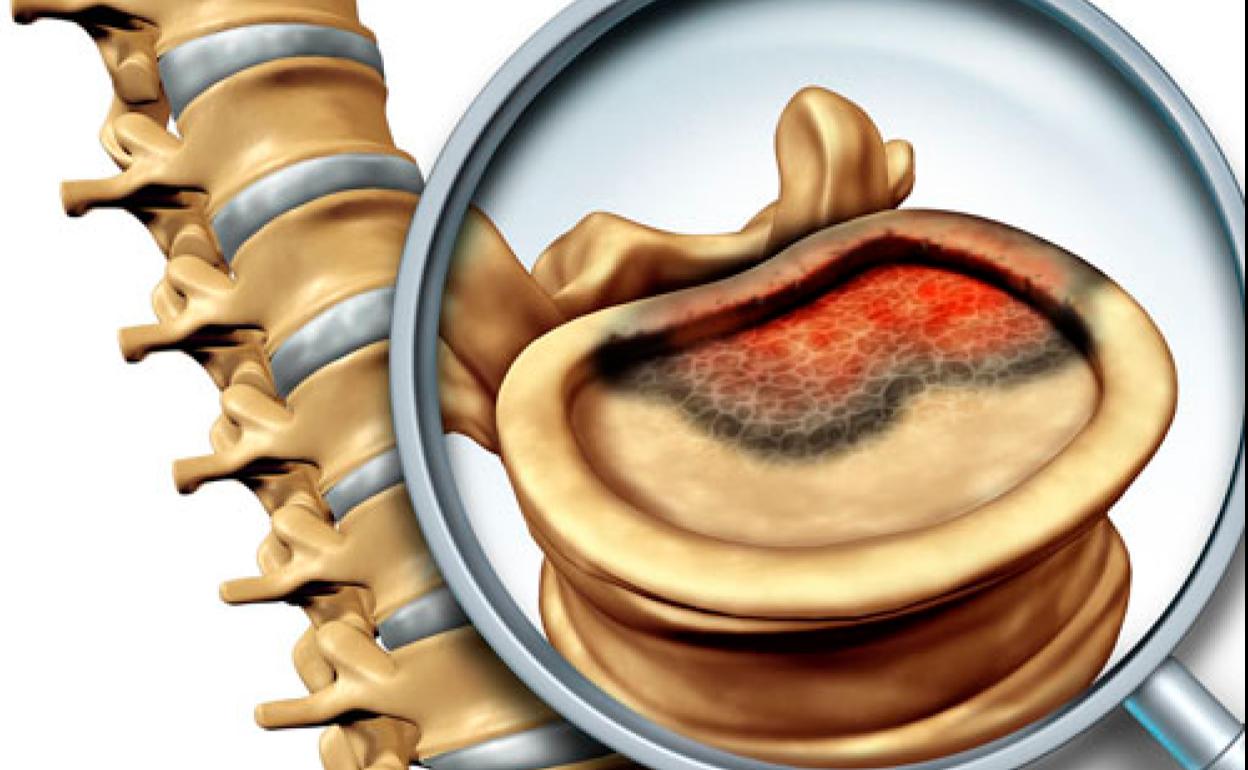 Muere Elena Huelva | así es el sarcoma de Ewing que tenía la joven