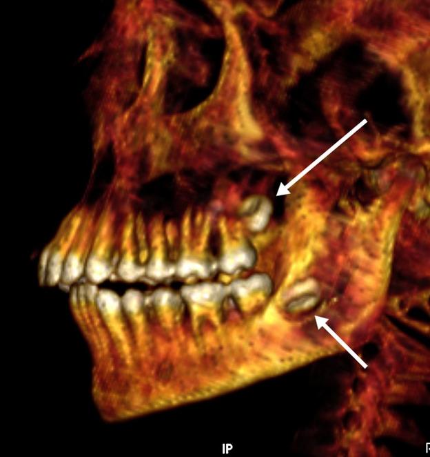 El escáner revela las muelas del juicio sin salir. El estado de la dentadura «es excelente».