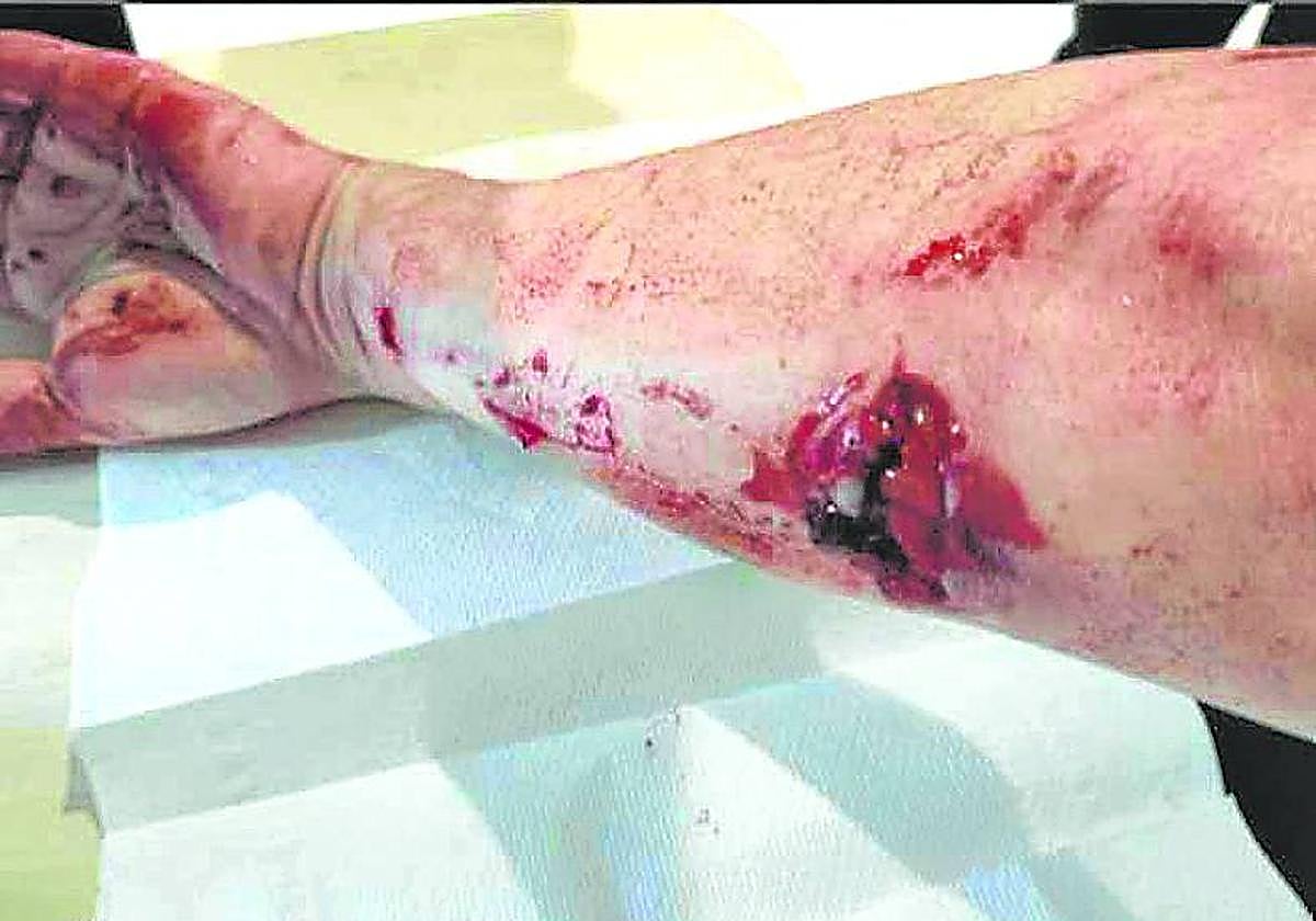 Herida que le provocaron los mastines a la montañera.