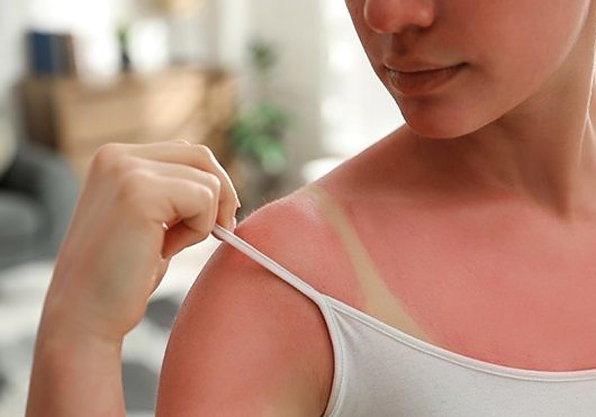 En qué consiste el callo solar, la «peligrosa tendencia» de la que advierte la OCU y que arrasa en TikTok