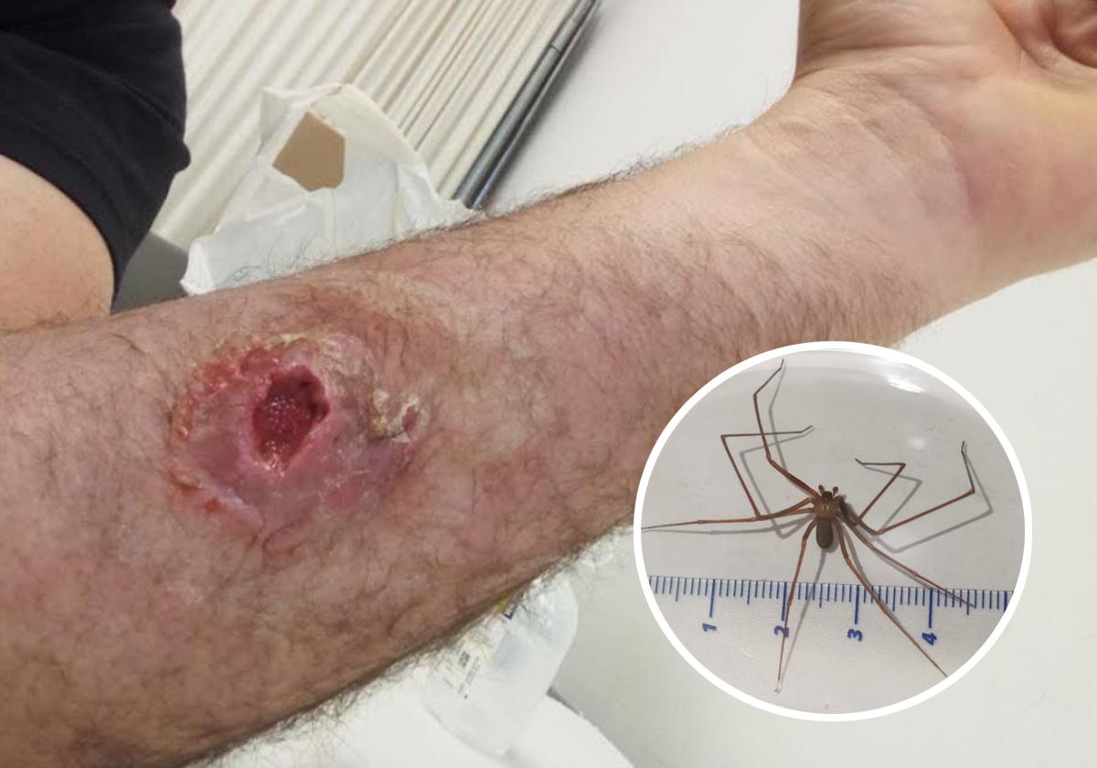 La venenosa araña violinista ataca en Bizkaia