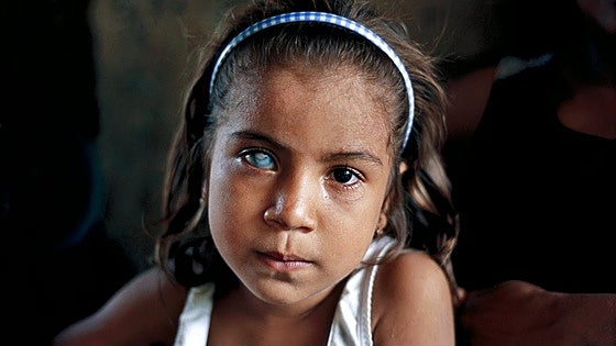 El Chernóbil del Amazonas: abortos espontáneos, cáncer, deformidades...