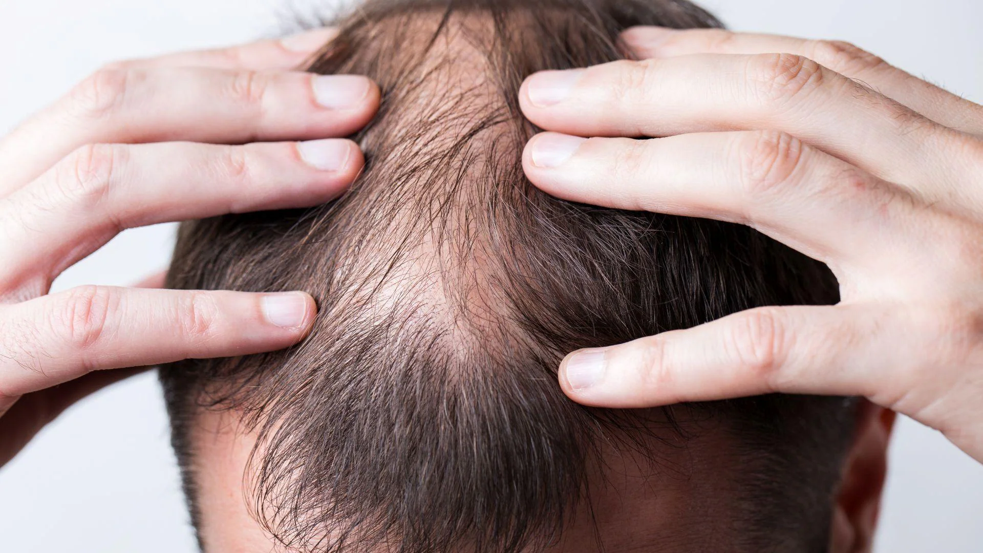 EU studies two anti-hair loss drugs due to suicide risk