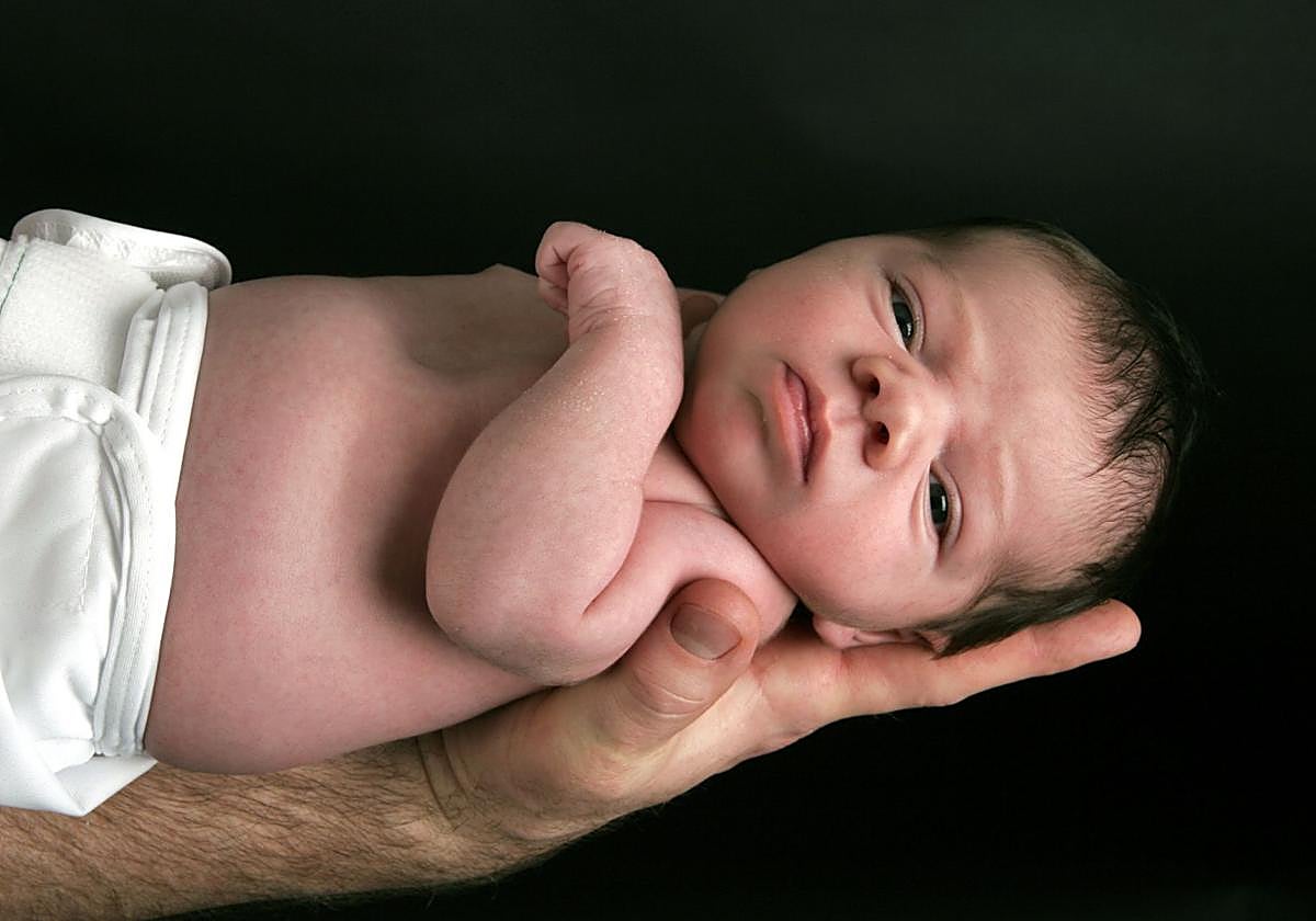 Qué es el síndrome del hombre lobo que ha afectado a 11 niños en Navarra