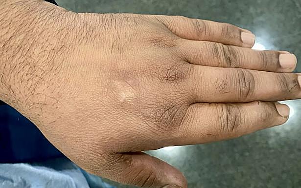 La cicatriz en la mano izquierda del sospechoso de agresión sexual.