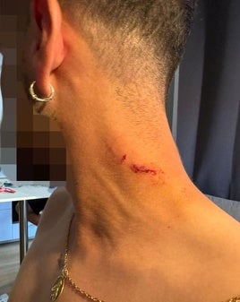 Una de las lesiones que sufrió el vecino de Gernika fue en el cuello.