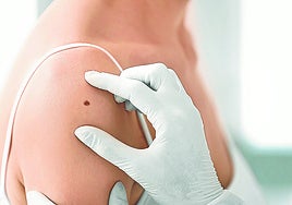 Los diagnósticos de cáncer de piel en Bizkaia se incrementan un 40% desde 2020