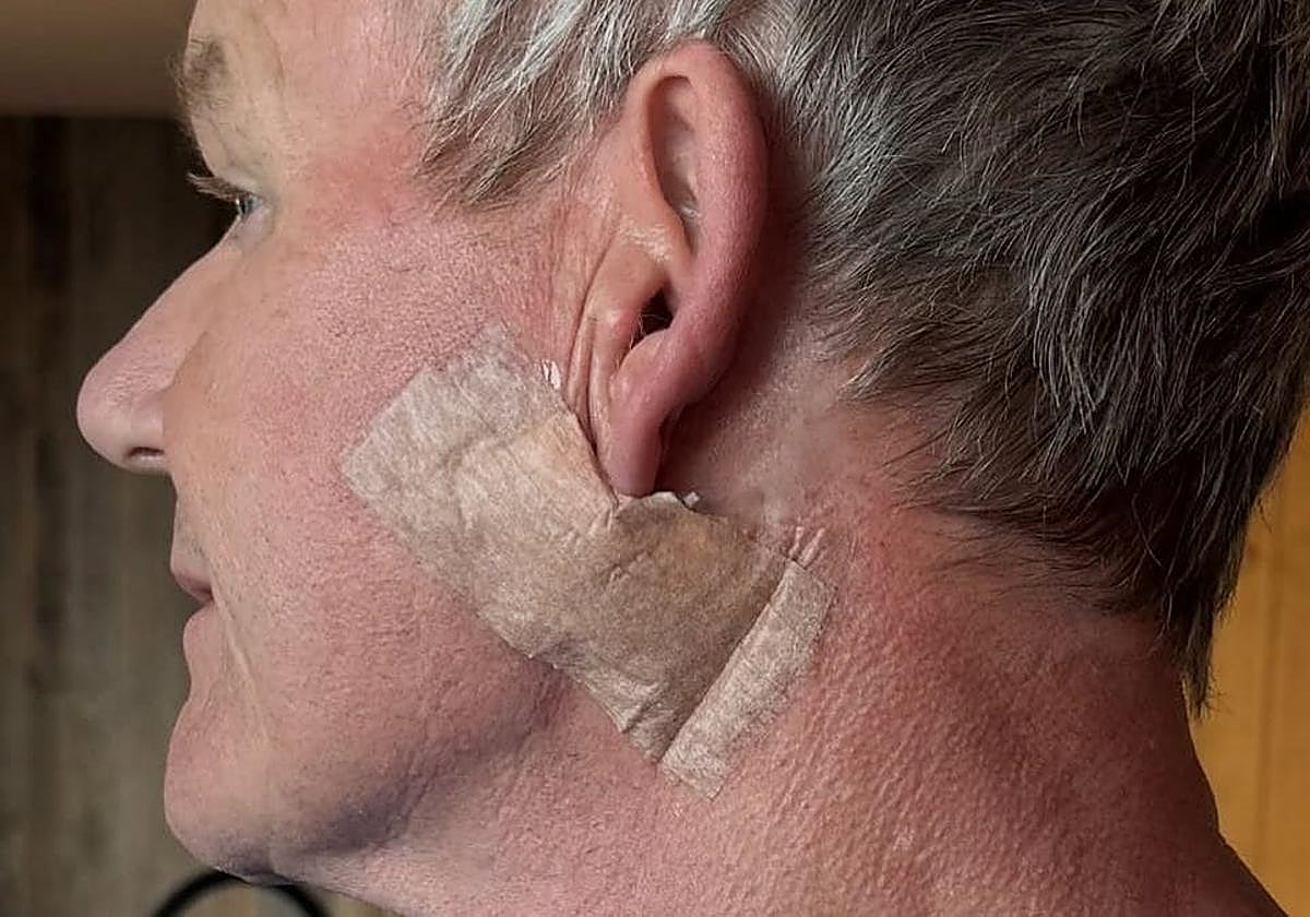 El chef anuncia en sus redes la operación para eliminar el cáncer de piel