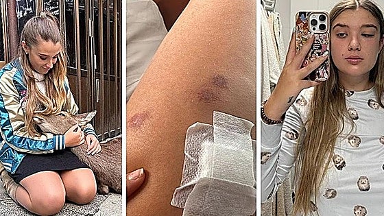 Una bailarina profesional de Castro, ingresada en una UCI de Alemania por la picadura de una garrapata