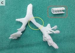 La pieza, en el recuadro rojo, encajando en la traquea impresa en 3D. / The New England Journal of Medicine