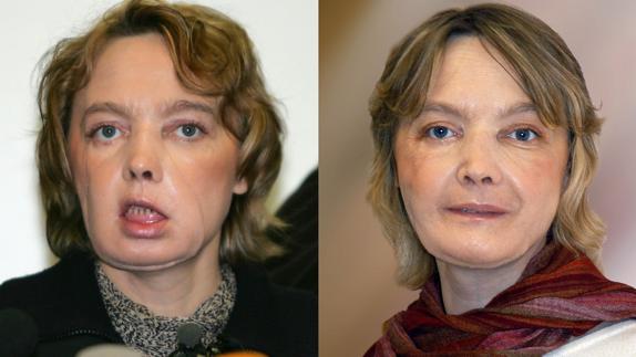 Isabelle Dinoire, antes y después de someterse a la intervención. 