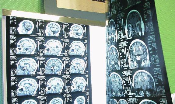 Dos radiografías de cerebros humanos dispuestas a ser analizadas en una consulta del Hospital Universitario de Donostia.