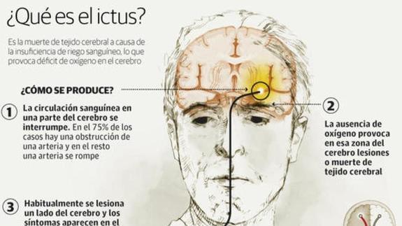 GRÁFICO: ¿Qué es el ictus?