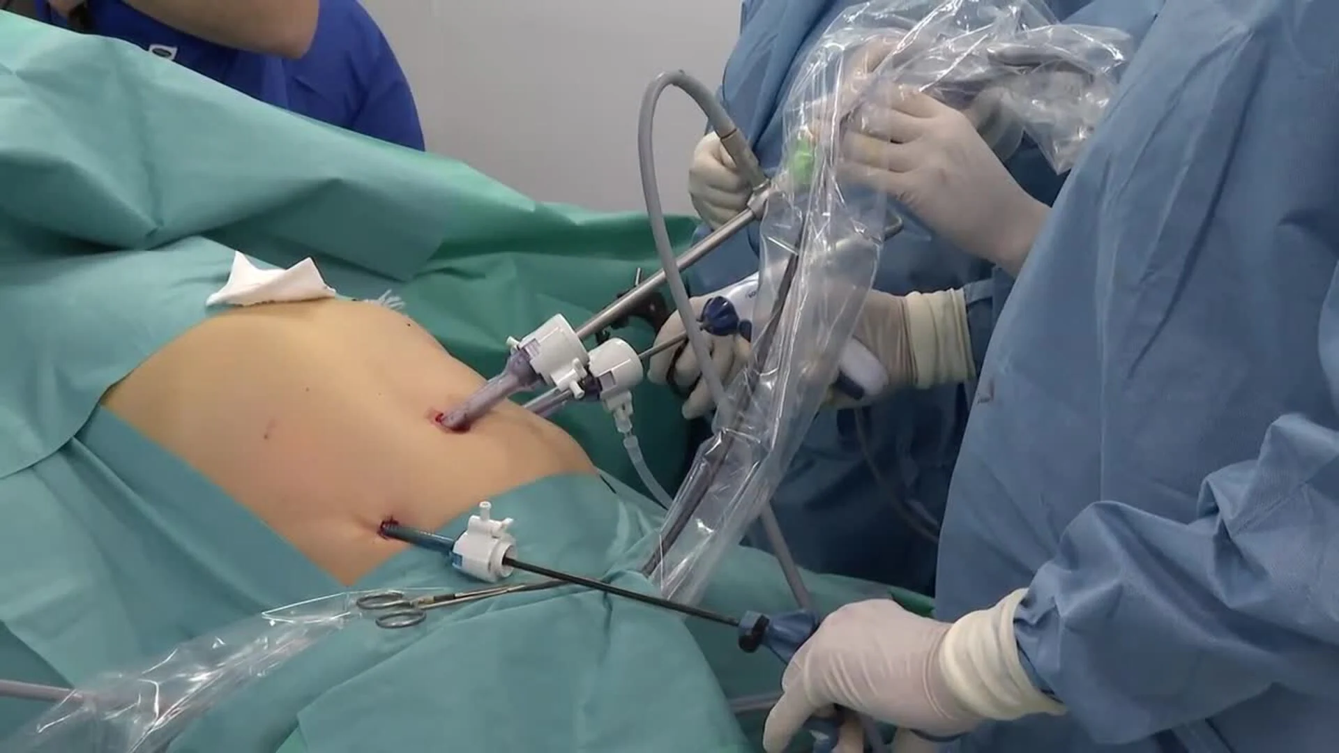 El Dr. Ballesta interviene en Barcelona un dolicomegacolon por laparoscopia y rayos infrarrojos