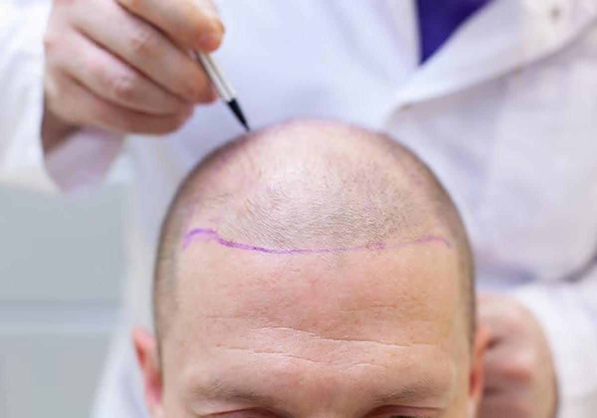 Muere un hombre de 38 años justo antes de someterse a un injerto capilar en Turquía