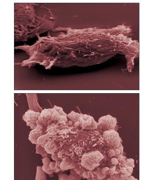 Composición de imágenes microscópicas de células cancerígenas. 