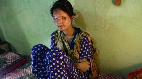 Reshma Qureshi tras el ataque de ácido.