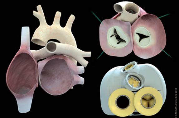 Corazón artificial elaborado por la empresa francesa Carmat.